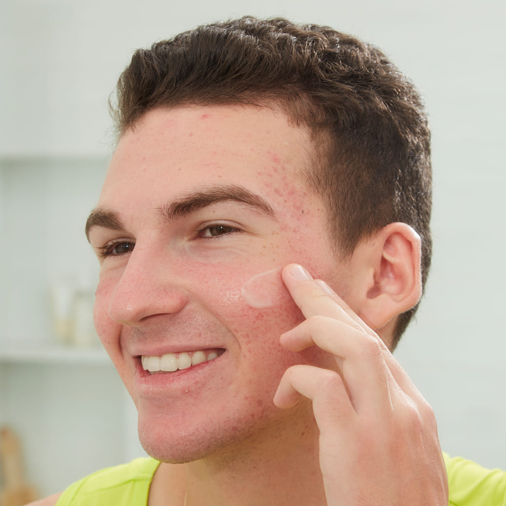 S&Eacute;RUM PARA EL TRATAMIENTO DEL ACN&Eacute; CON &Aacute;CIDO SALIC&Iacute;LICO (S&Eacute;RUM FACIAL)